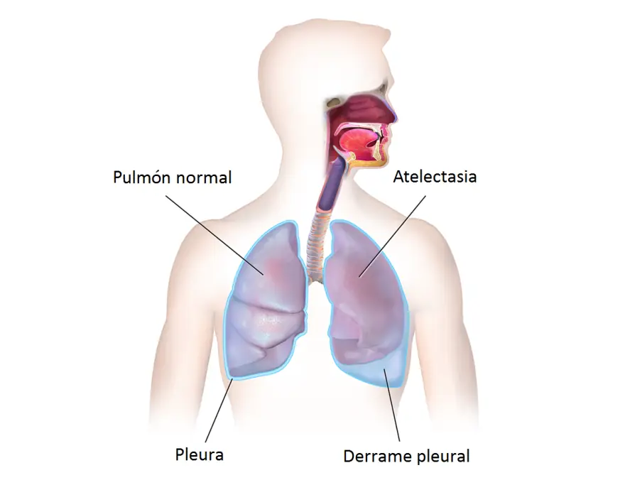 Figura 1.2. Pleura, una membrana serosa: el derrame pleural ocupa la cavidad virtual entre sus hojas.