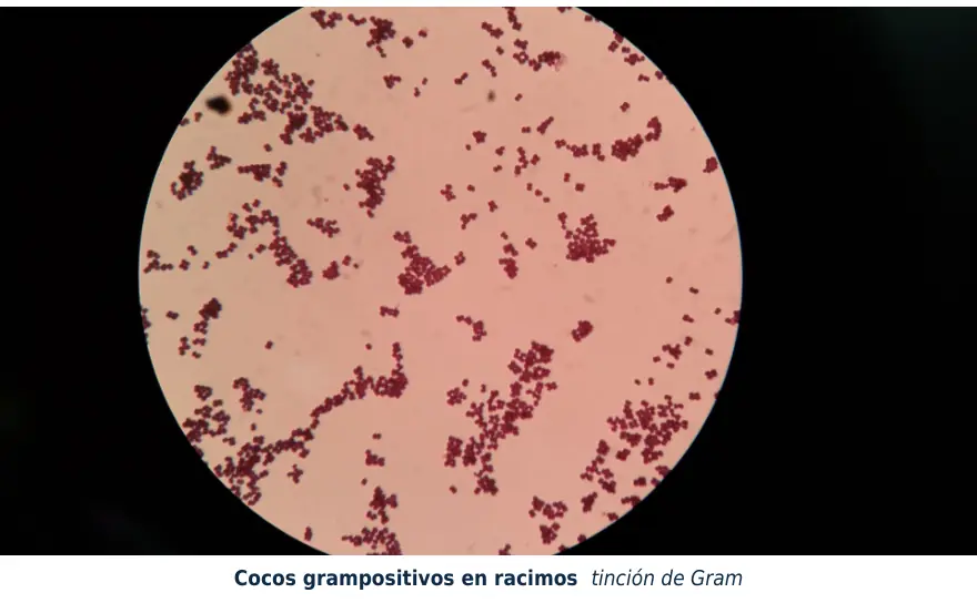 Figura 1.2. Tinción de Gram de pus: cocos grampositivos (morados) aislados, en pares y en racimos, el patrón del estafilococo.